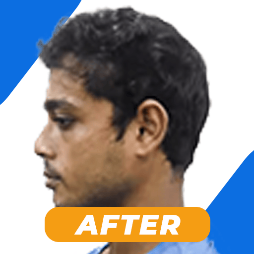 Best hair transplant in kolkata