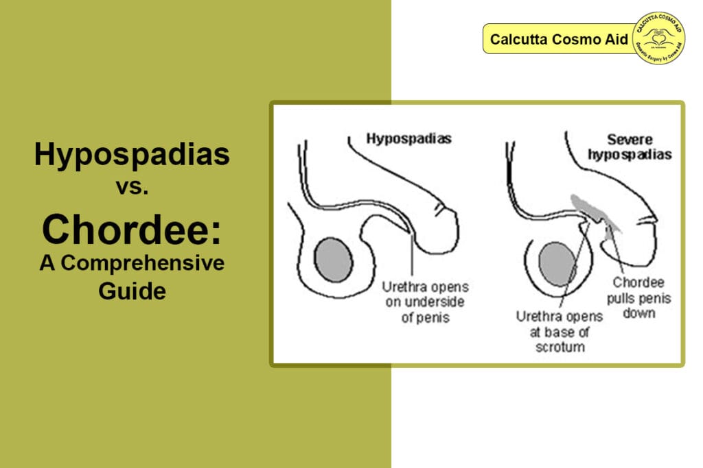 Hypospadias vs. Chordee 1