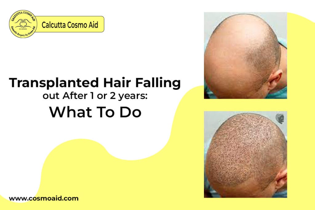 Transplanted Hair Falling out