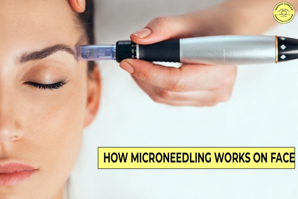 how microneedling works on the face