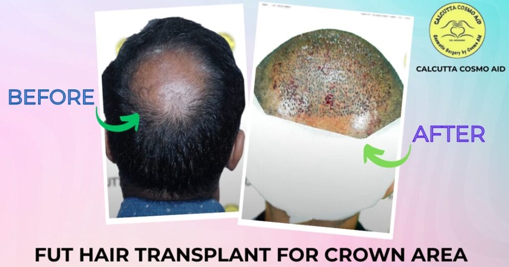 hair transplant