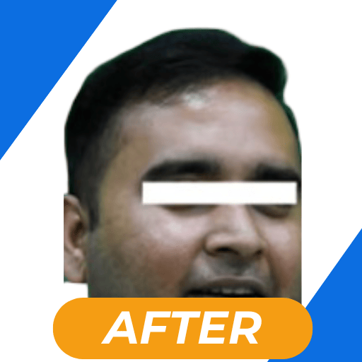 Best hair transplant in kolkata