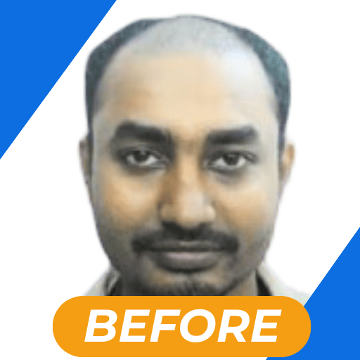 Best hair transplant in kolkata