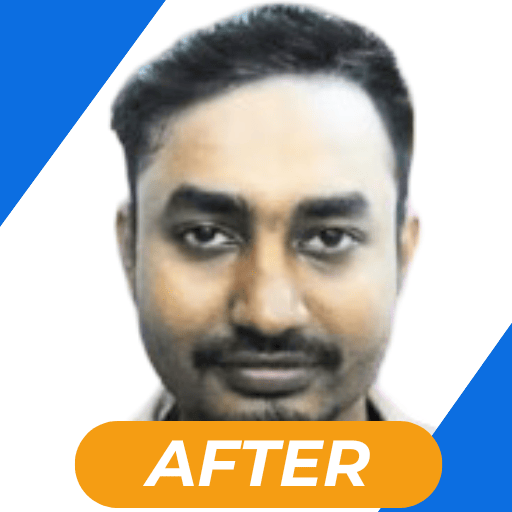 Best hair transplant in kolkata