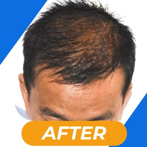 Best hair transplant in kolkata
