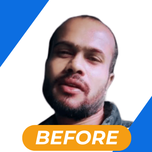 Best hair transplant in kolkata