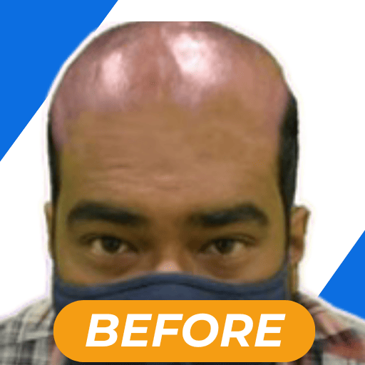 Best hair transplant in kolkata