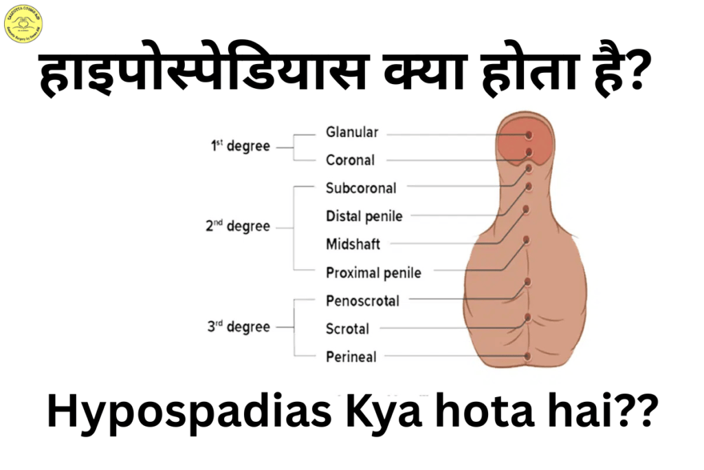 Hypospadias