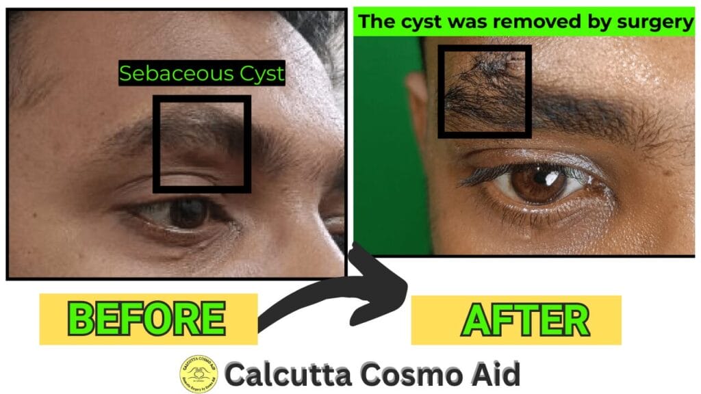 Cyst